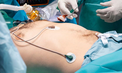 Hernia — Laparoscopic Repair