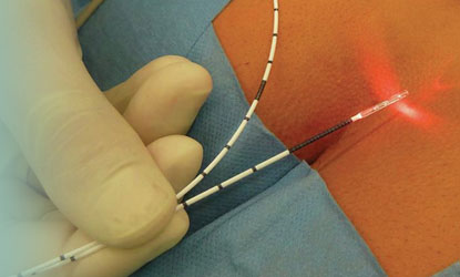 Pilonidal Sinus — Laser