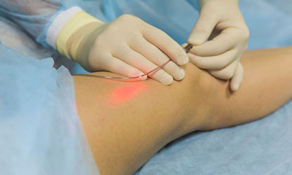 Varicose Veins — Laser